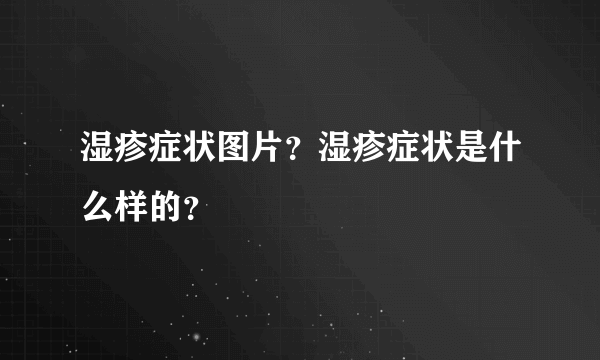 湿疹症状图片？湿疹症状是什么样的？