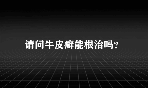 请问牛皮癣能根治吗？